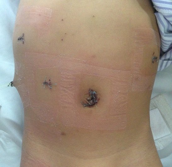 海南完成省内首例腹腔镜下先天性胆总管囊肿根治手术