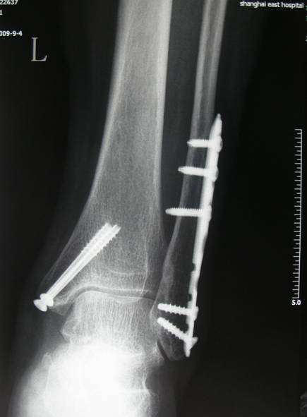 微创双踝骨折术后取内固定