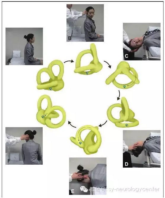 良性阵发性位置性眩晕——耳石症