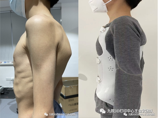 脊柱全长x光片显示胸椎后凸畸形55°.