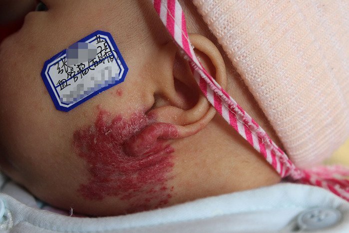 两岁宝宝左耳"混合血管瘤"治疗一次好转大半 - 微医(挂号网)