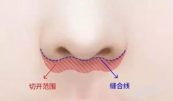 (图三)人中缩短的手术方式治疗的方法中最彻底,最永久,最流行的就是在