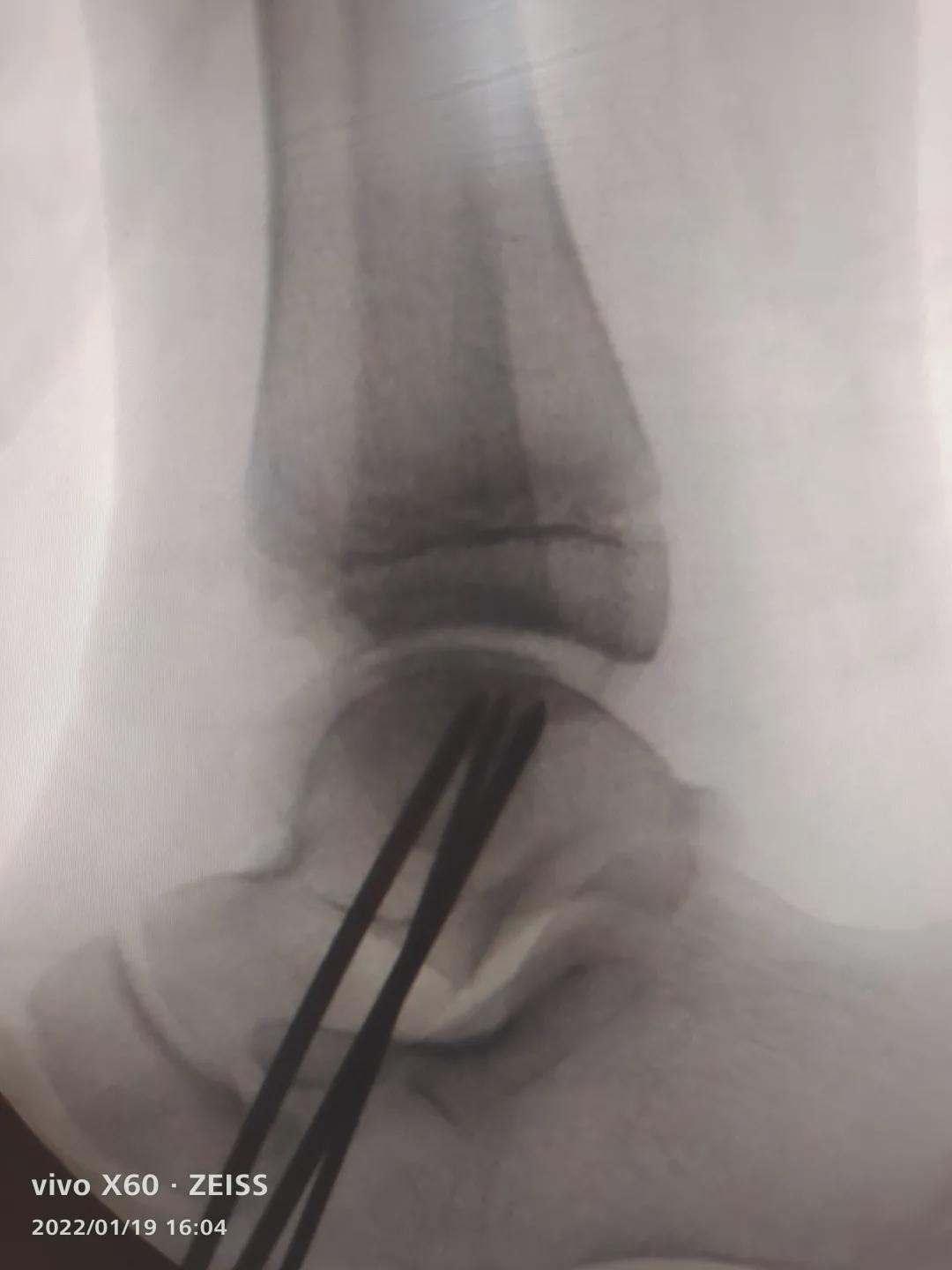 各种类型踝关节距骨软骨损伤微创治疗部分案例 - 好大夫在线