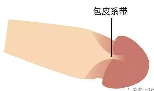 包皮系带是男子阴茎头腹侧正中或包皮内板与尿道口相连的皮肤皱襞,呈
