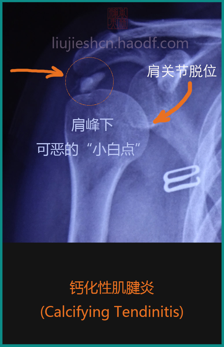 肩关节疼痛病例1冈上肌钙化性肌腱炎calcific