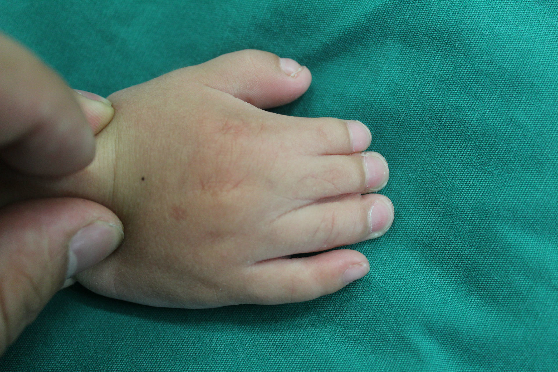 波兰氏综合征的诊断与治疗