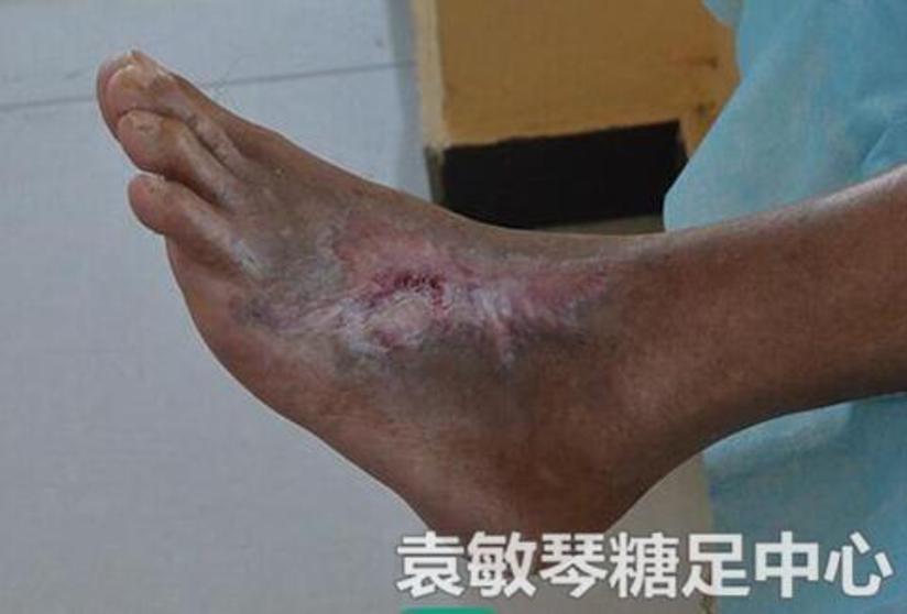 由糖尿病引起的烂脚应该怎么治 健康号 微医