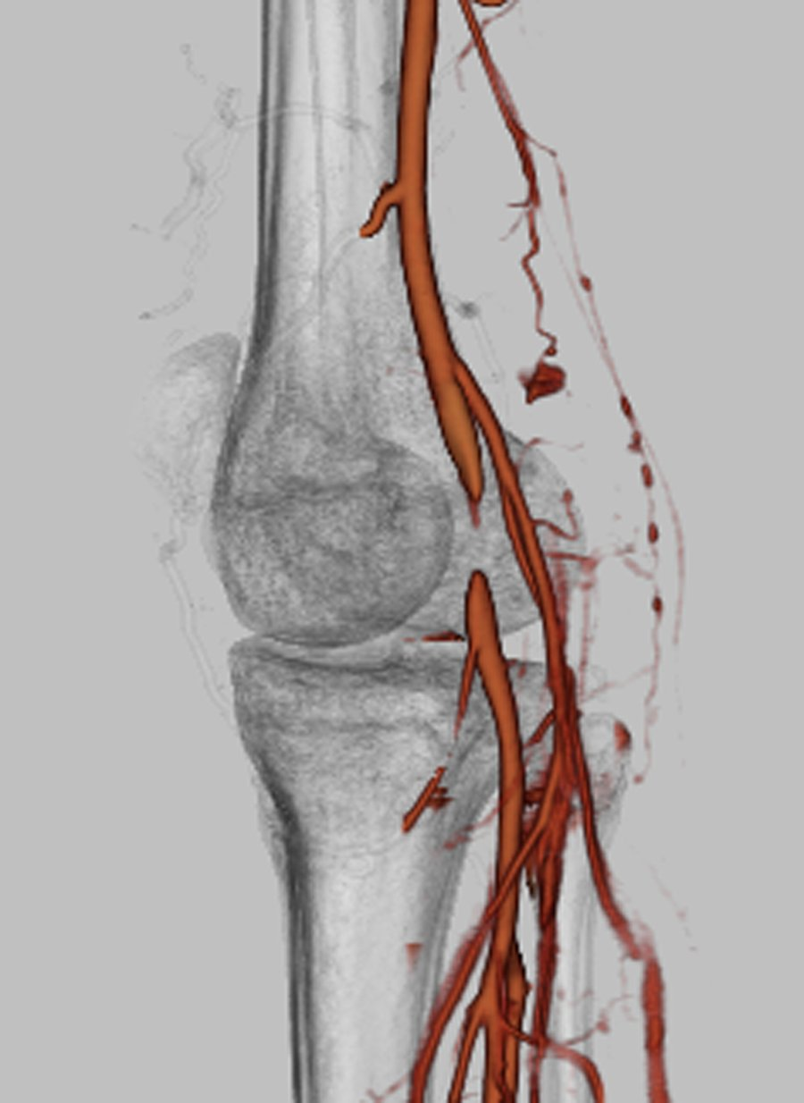 图文解码腘动脉陷迫综合征(paes)_吕平医生文章_华中科技大学同济医学