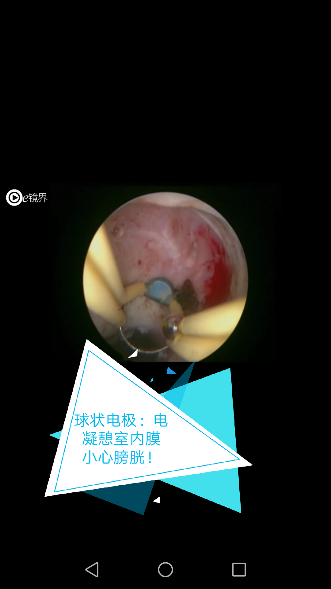 手术解析宫腔镜下切除剖宫产术后子宫切口憩室