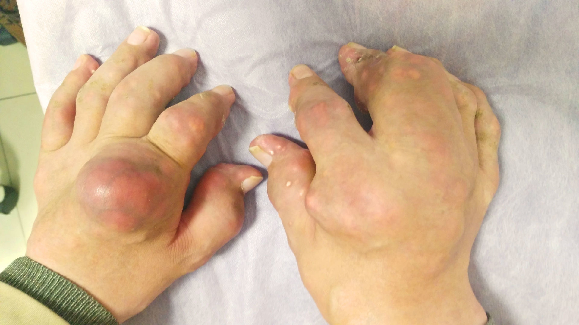 痛风晚期大量尿酸盐结晶形成痛风石可致残:急性发作期不应新加用降血