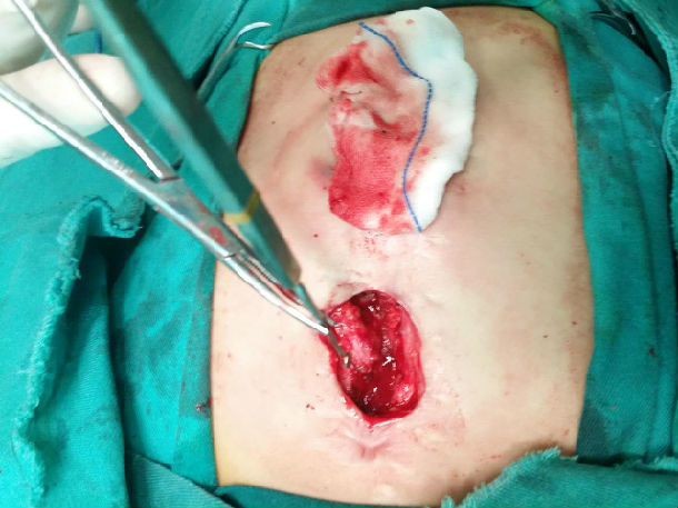 心脏手术后胸部慢性窦道并感染