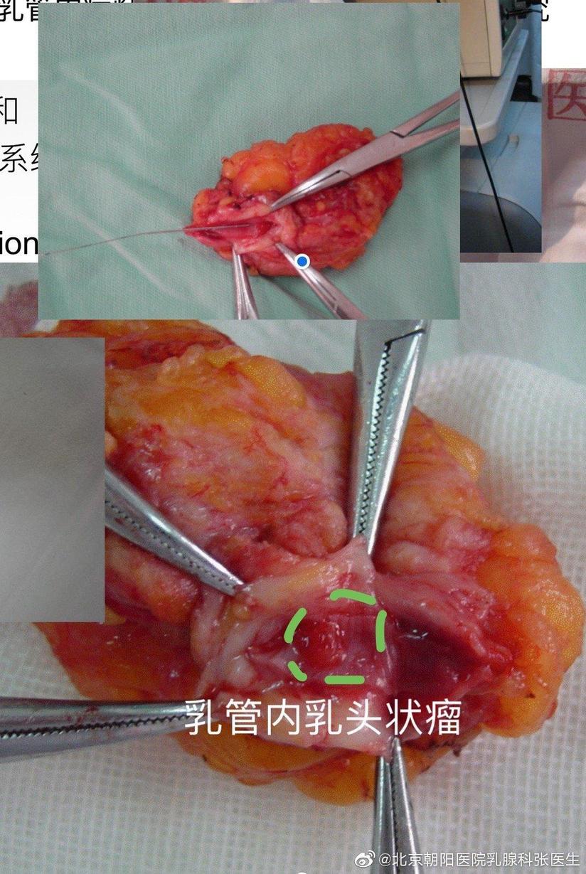 乳管镜 造福女性患者 遵义医科大学附属医院