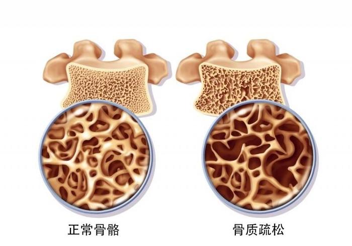 骨质疏松症其实是由于骨量减少,骨微观结构退变,导致骨强度降低,脆性
