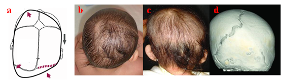 颅缝早闭主要表现为头型异常,但人字缝早闭仍需和长期体位因素引起的