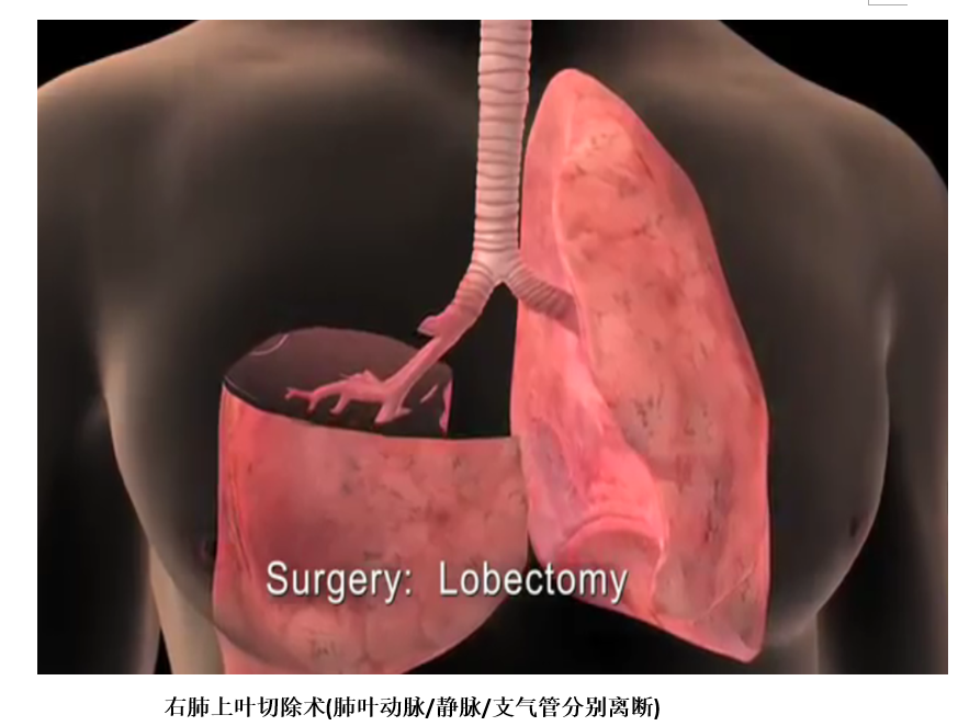 肺楔形切除术示意图图片