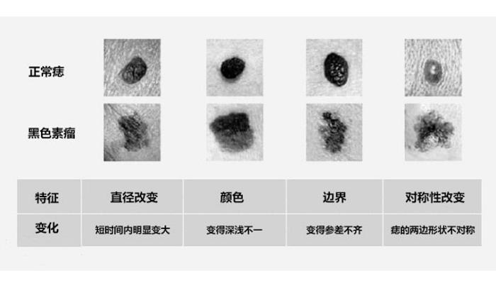 色素痣应该如何判断及其治疗措施