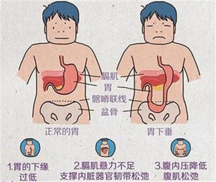 胃下垂你了解吗