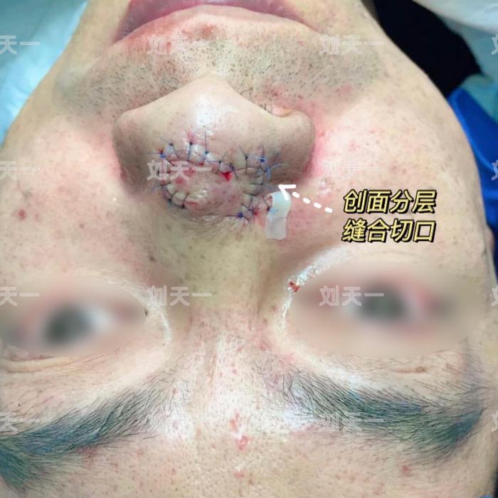 鼻部皮瓣转移术根治皮肤肿瘤_刘天一医生文章_复旦大学附属华东医院