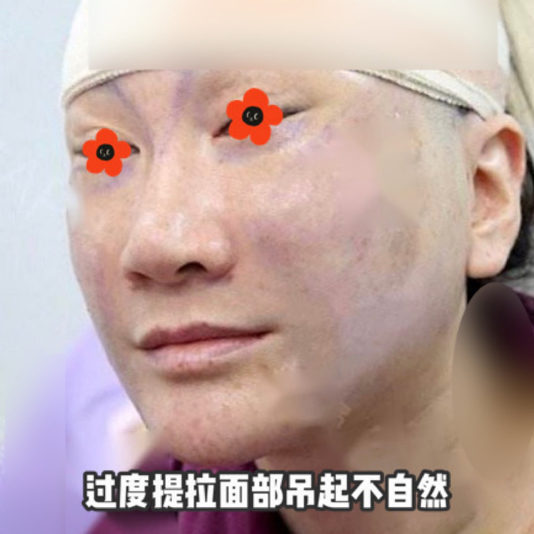 分层拉皮具有独到的面部提升优势,最主要的原因是针对面部衰老的机制