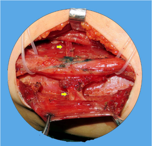 moebius莫比乌斯综合征是什么鬼先天性面瘫怎么治