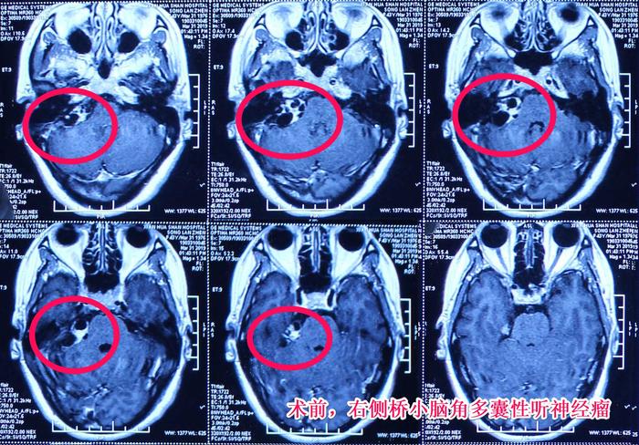 病例分享高难度多囊性听神经瘤病例分享