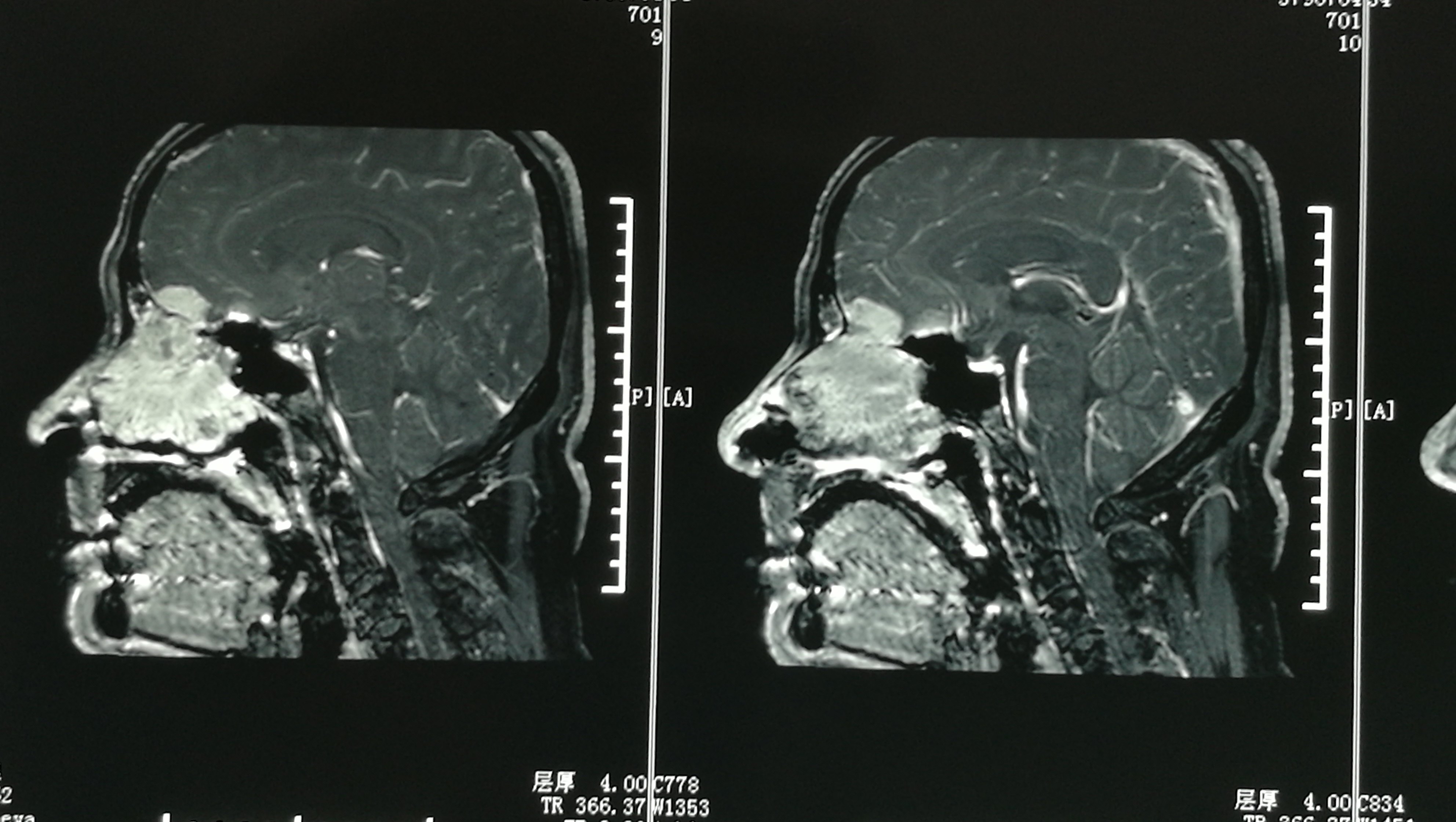 髓母细胞瘤的影像学特征 | The Neurosurgical Atlas全文翻译 - 脑医汇 - 神外资讯 - 神介资讯