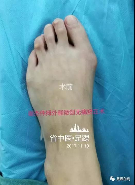 拇外翻俗称大脚骨的微创无痛美容矫正术