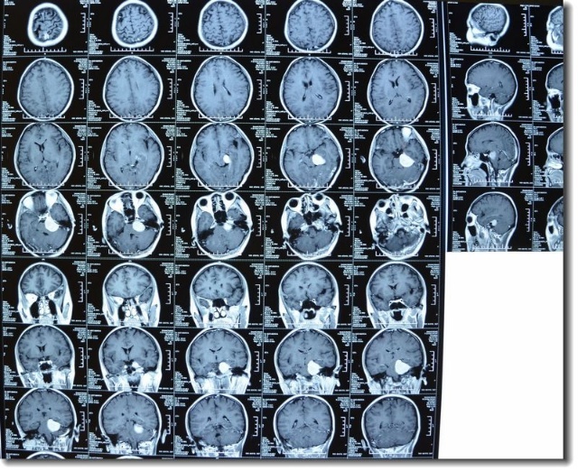 贺晓生教授手术回顾桥脑角脑膜瘤手术