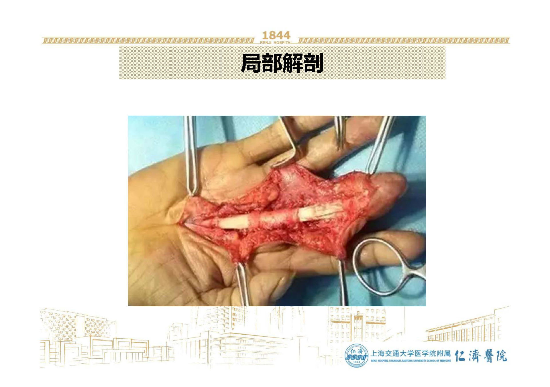 61成人,儿童均可患病61拇收肌腱止于尺侧籽骨上.