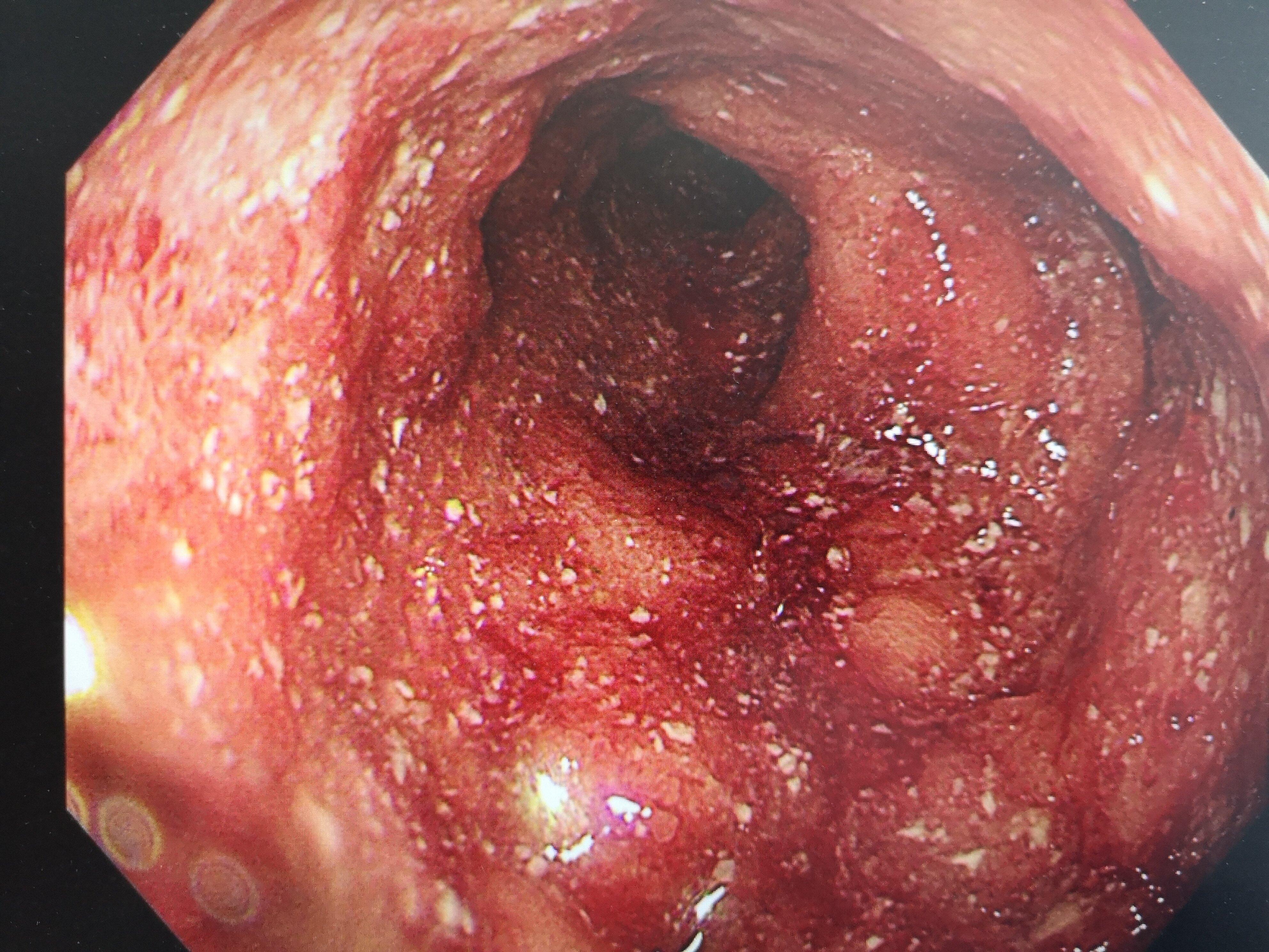 溃疡性肠结核图片