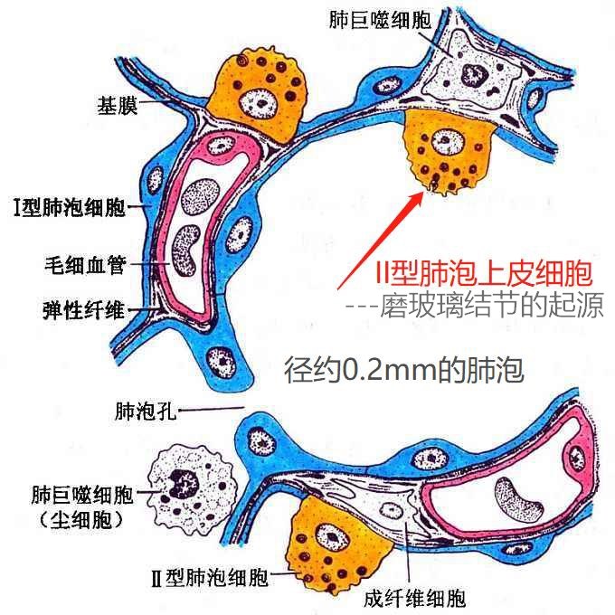 上面是简化图,黄色的就是ii型肺泡上皮细胞,发生不典型增生出现增大