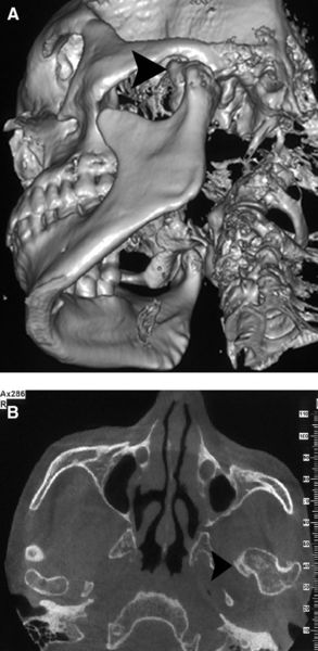 颞下颌关节髁突骨软骨瘤的发生部位有图片
