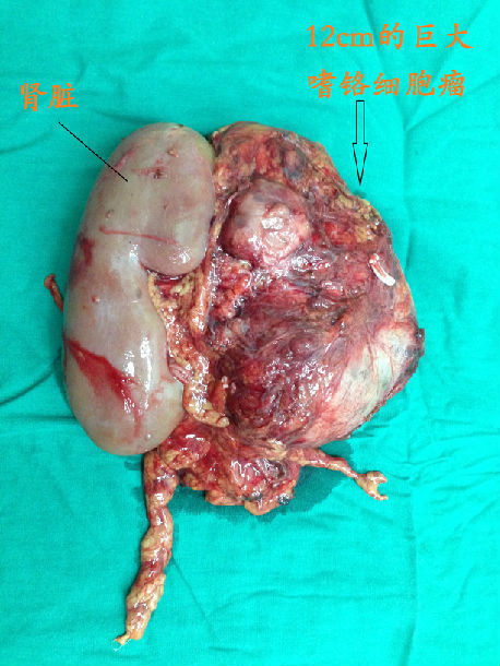一例与肾脏相连的巨大嗜铬细胞瘤