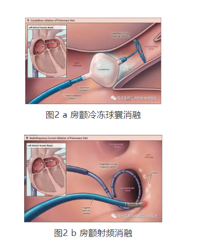 冰与火之歌房颤冷冻球囊消融与射频消融术