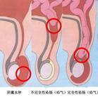 小儿腹股沟斜疝