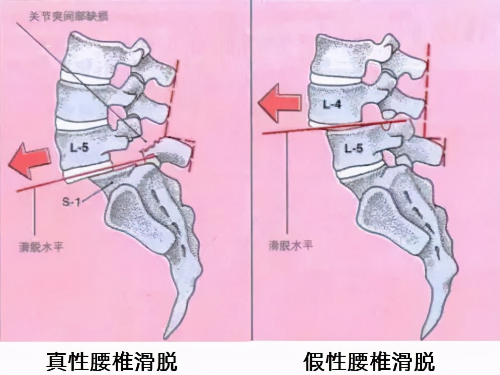 腰椎滑脱了可以手法复位吗