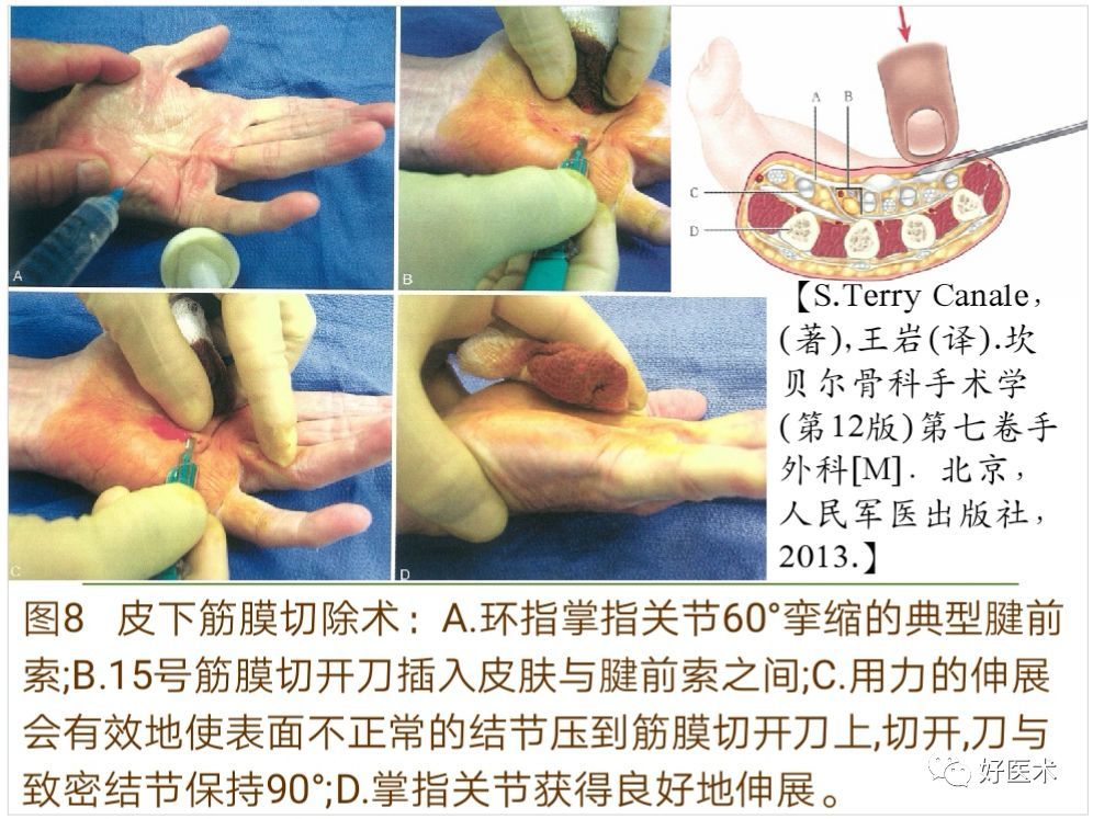掌腱膜挛缩症的诊治技巧系统详解