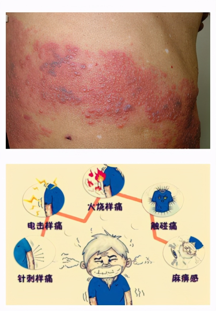 带状疱疹不得不说的痛