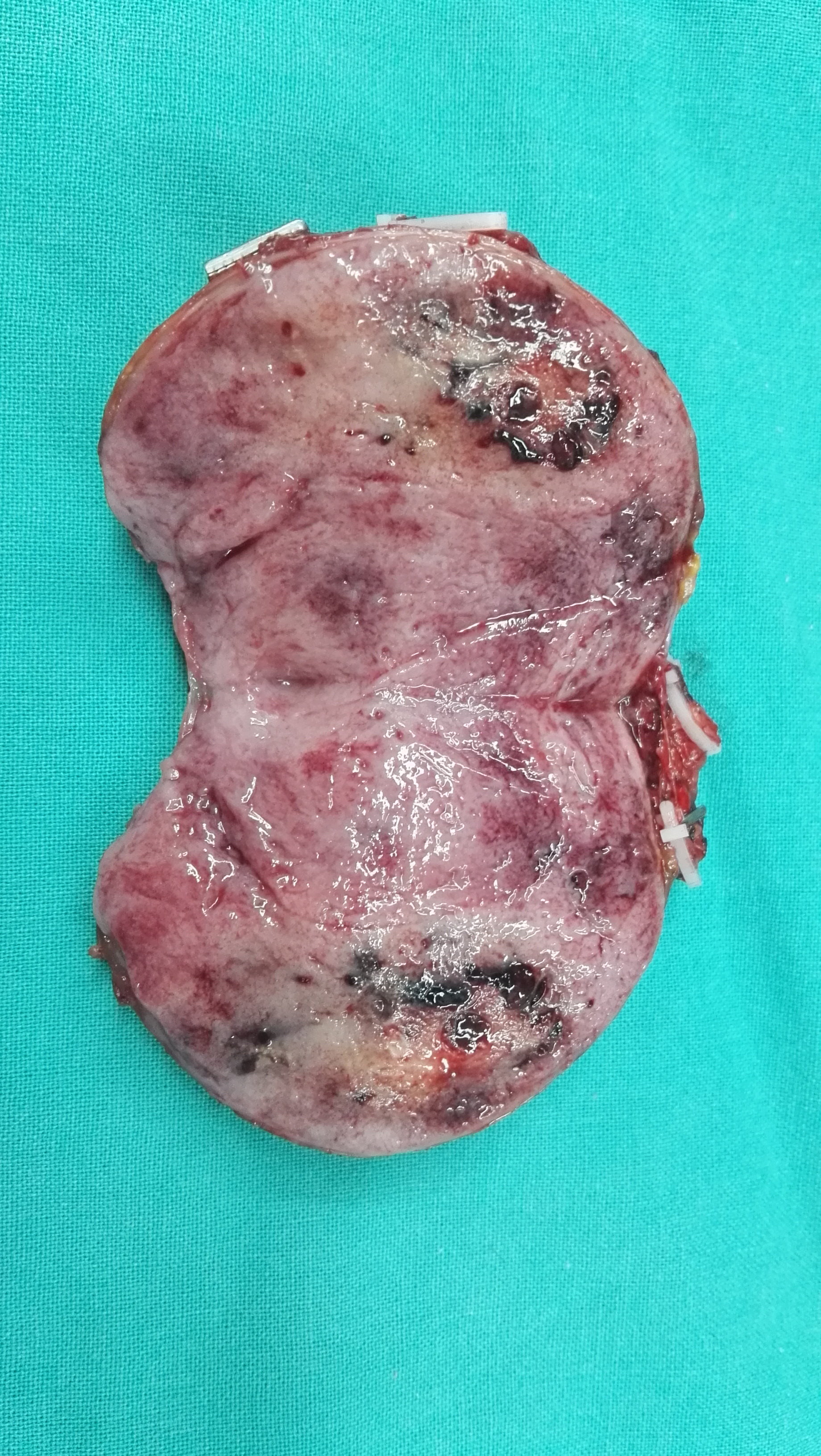 右侧巨大嗜铬细胞瘤微创切除同时保留肾脏 - 微医(挂号网)