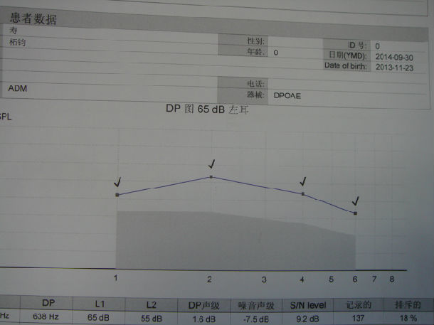 图4  治疗7月后右耳dpoae正常