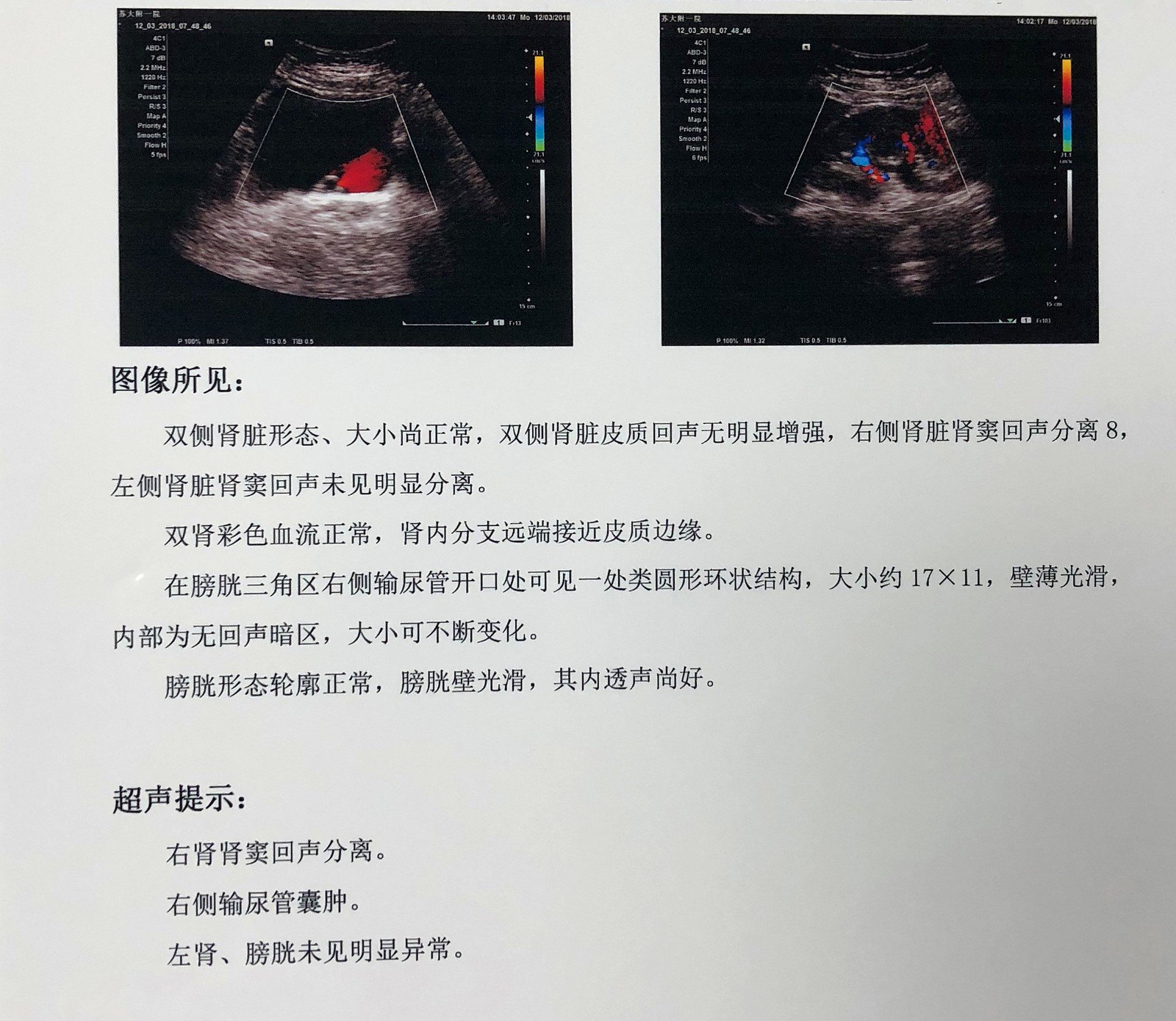 以致输尿管下端各层形成一囊肿突入膀胱之内