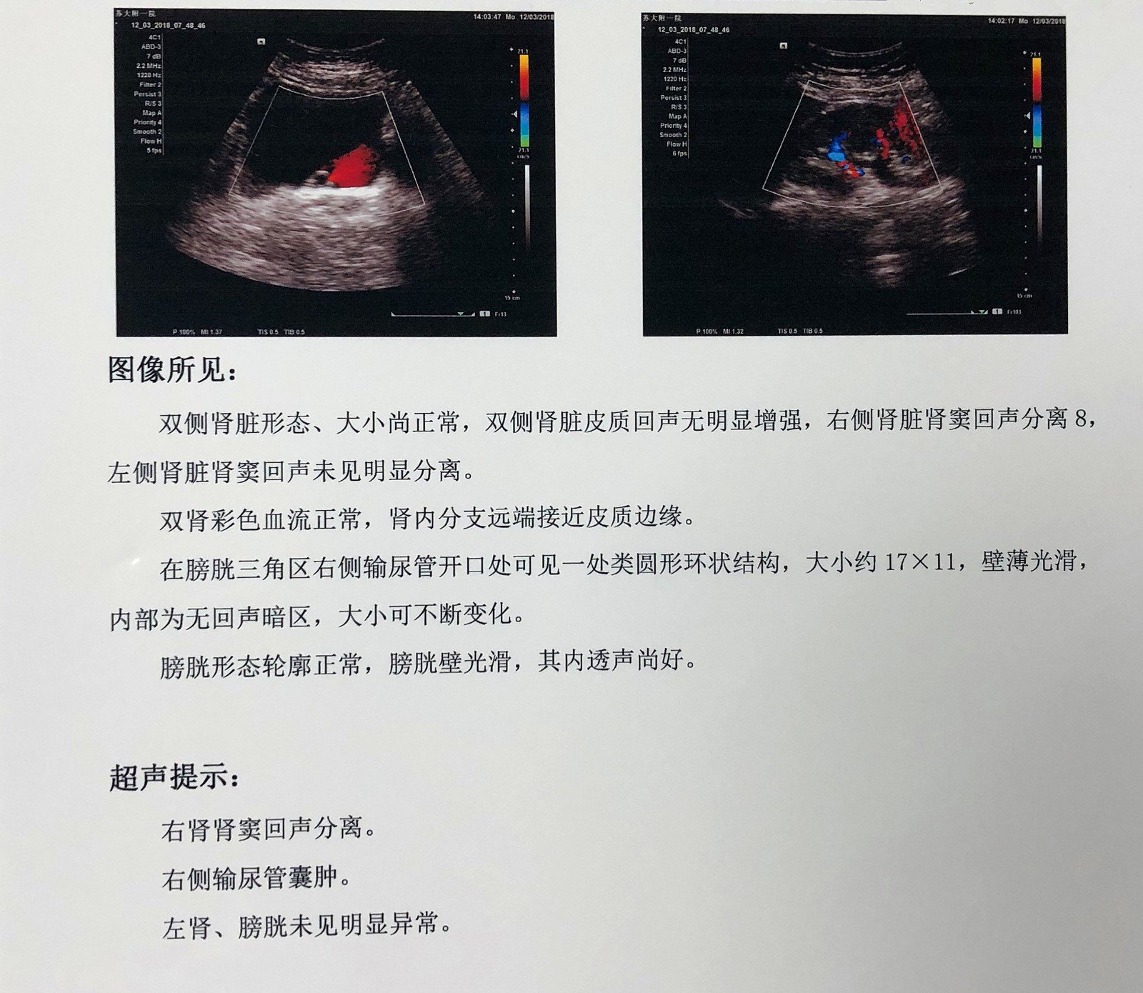 膀胱囊肿超声图片图片