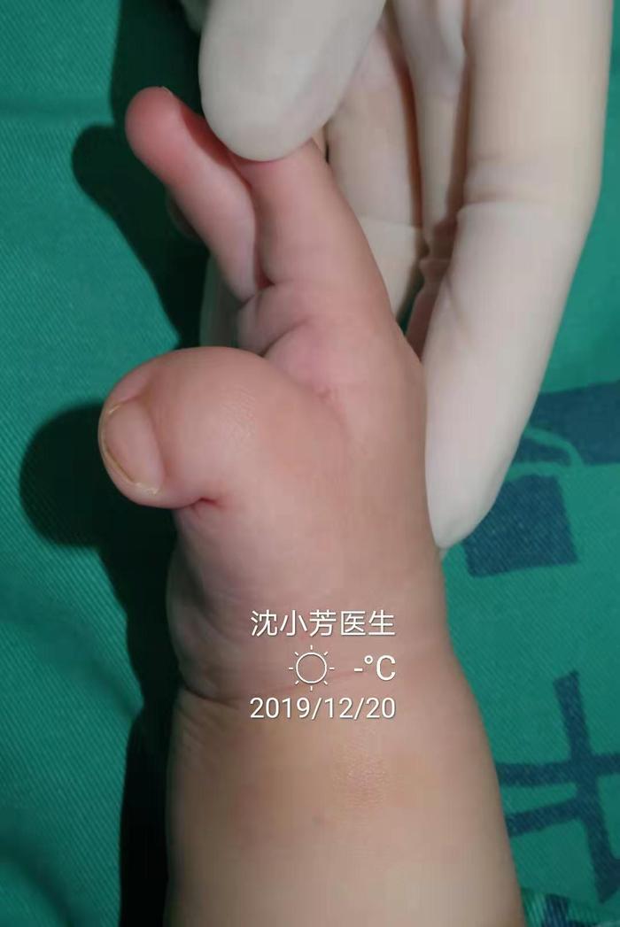 這個是特殊病例,不是apert syndrome(波蘭綜合徵)而是pfeiffer