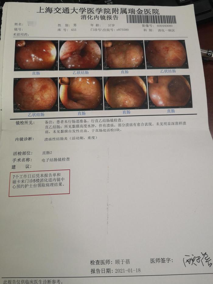 青玉散中西医结合治疗让激素依赖型难治性溃疡性结肠炎患者稳定病情