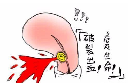 (2)孕中晚期:如果瘢痕子宫妊娠到中晚期,形成前置胎盘,胎盘粘连植入