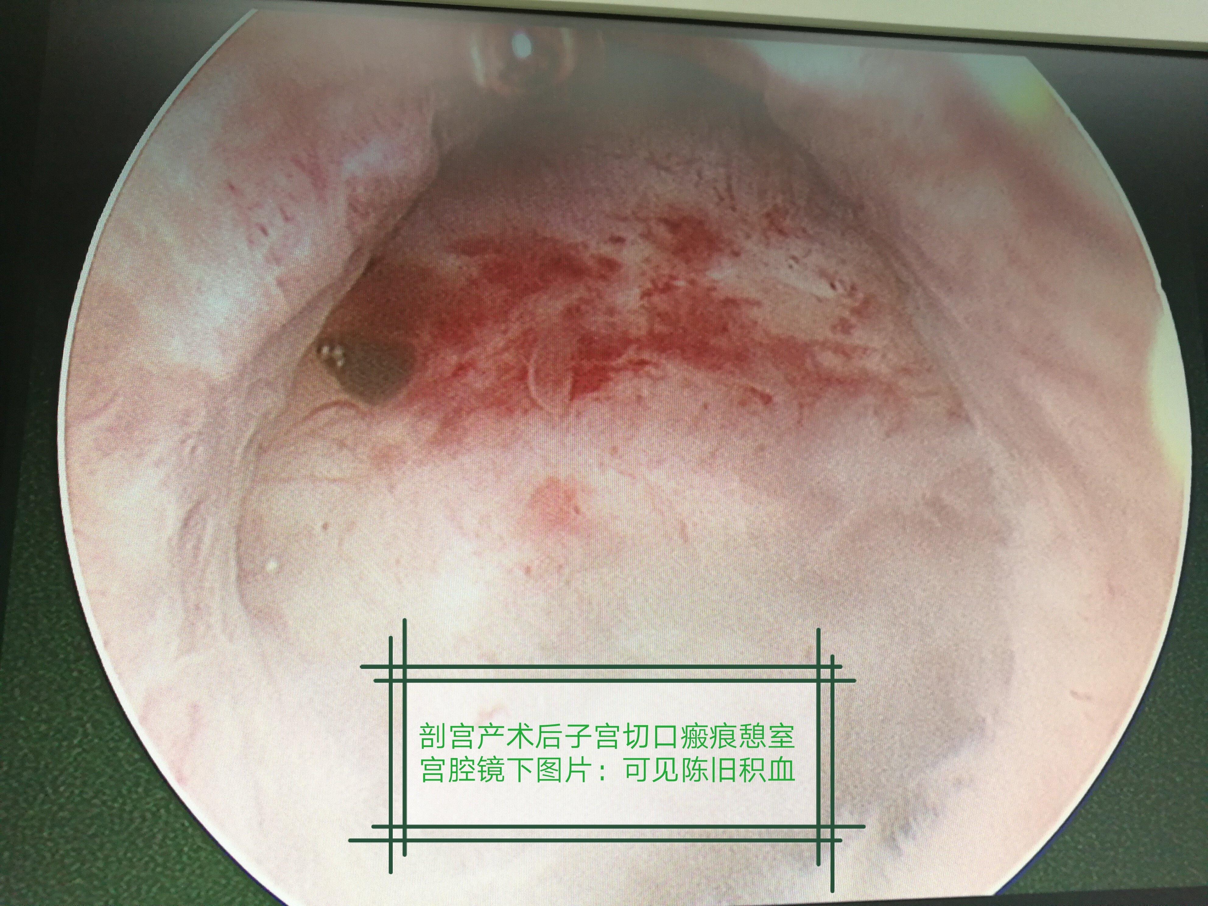 手术解析宫腔镜下切除剖宫产术后子宫切口憩室