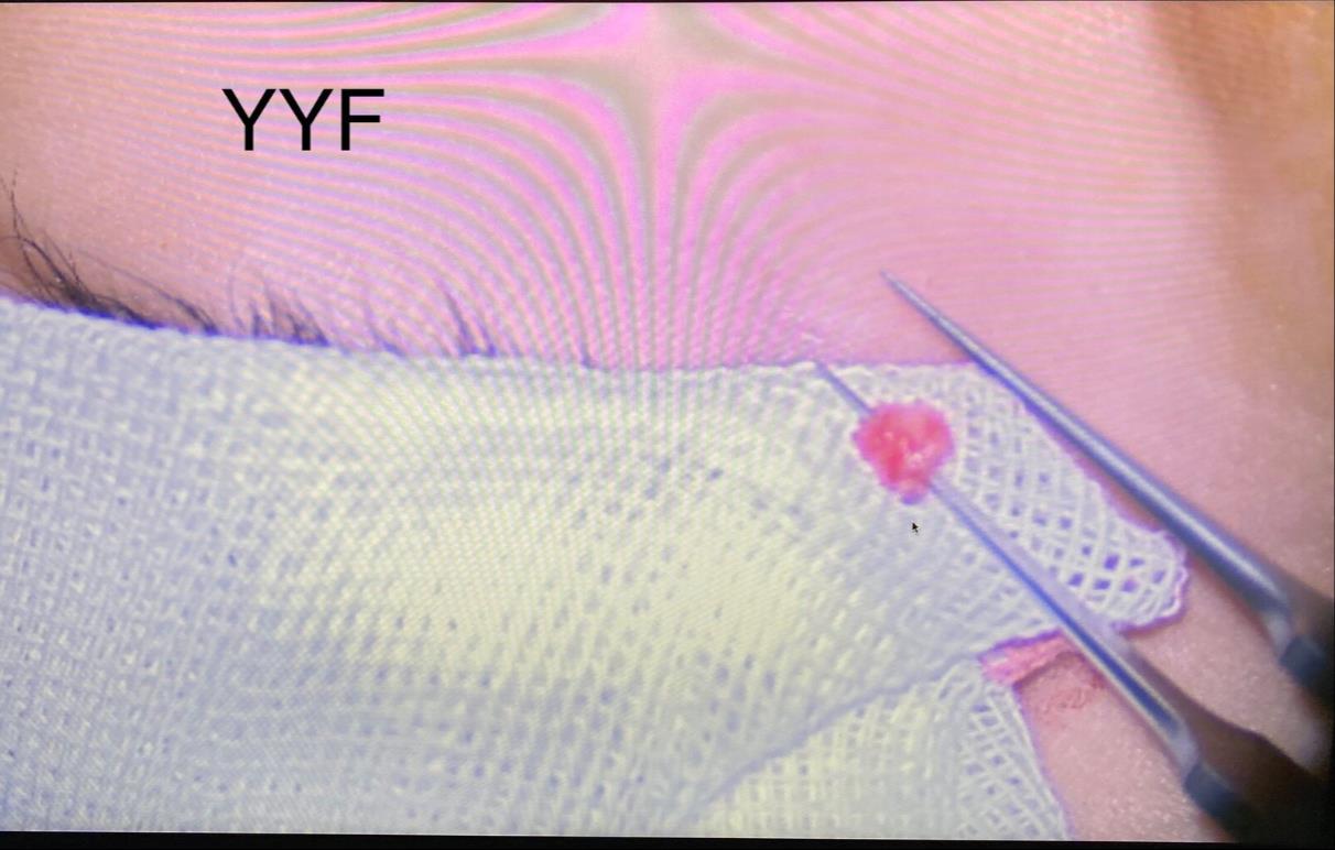 先天性泪囊瘘管的切除和手术指征泪道系列之十二