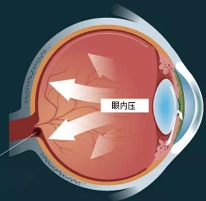 现代的眼压偏低是有什么影响的图像