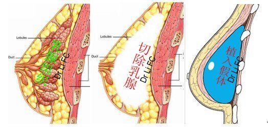 左图示乳房的组成:最外是皮肤包被(skin envelop ),中间为乳腺(breast