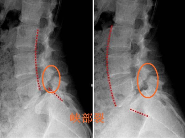 就称为腰椎滑脱(图1)